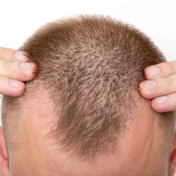 How Steroids Affect Hair Follicles